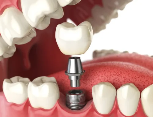 Les nouvelles techniques d’implantologie pour une meilleure intégration osseuse