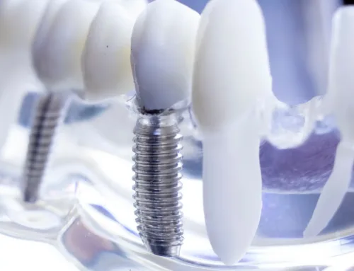 Implants dentaires : innovations technologiques pour une meilleure intégration